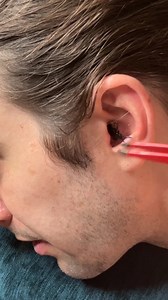 man gets strange object removed from ear A man came in today with a weird feeling in hi sear. We did some feeling around and found an onject that needed to be removed. We did all this without calling a doctor. He was never in any pain and the object was safely removed. Please be advised that this page’s videos are intended for entertainment purposes only. The videos on this page include scripted dramas, satires, parodies, magic tricks, pre-recorded videos, and other forms of entertainment. Names