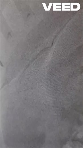 Selective angiographic transarterial embolization represents a minimally invasive and effective treatment option for giant hepatic hemangiomas, utilizing a combination of Bleomycin and Lipiodol to… | Hazem M. Almasarei