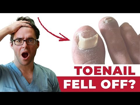 Toenail Falling Off? How To Make It Grow Back! [Top 4 Causes]