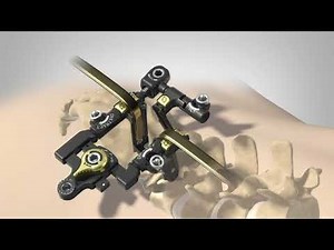 MAS™ TLIF 2 Retractor System