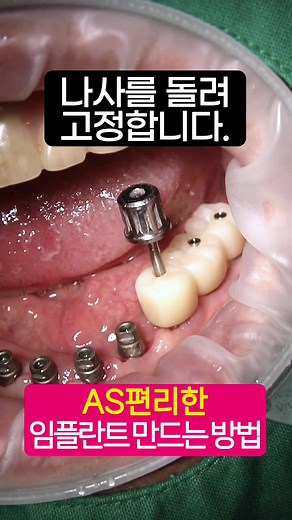 치과 크라운 설치과정 및 유지관리 방법