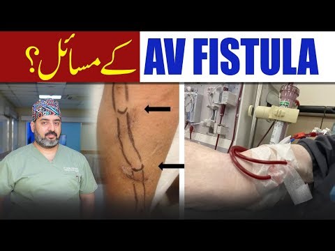 Complications of AV Fistula