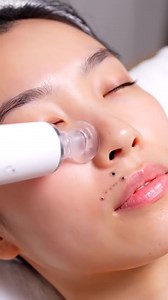 4.7K views · 14 reactions | Most Satisfying Blackhead Vacuum Ever! | Pimple Popping | Facebook