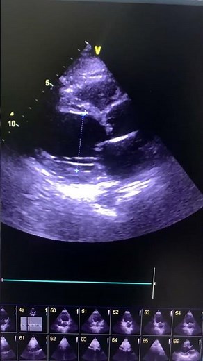 Her MRI confirmed the Sarcoidosis (chronic).