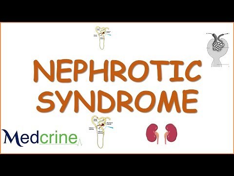 NEPHROTIC SYNDROME causes,pathophysiology,diagnosis,features and treatment