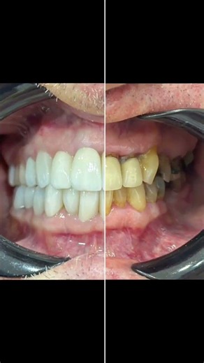 The Result of Dental Crowns & Implants at 60 | Saigon White Dental