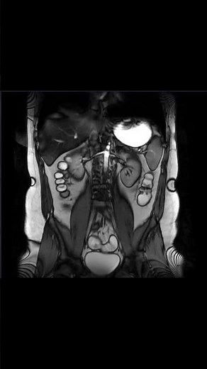 MRI ENTEROGRAPHY #anatomy #animation #mri #abdomen