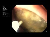 Stomach Foreign Body • Video • MEDtube.net