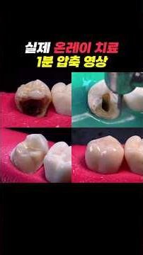 Onlay Cavity Treatment | 1-Minute Summary of the Entire Process