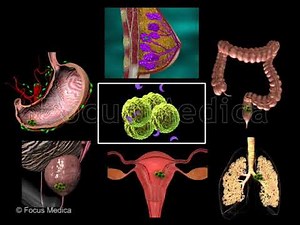 Expression of COX 2 - Animated Atlas of Breast and Gastric Cancer