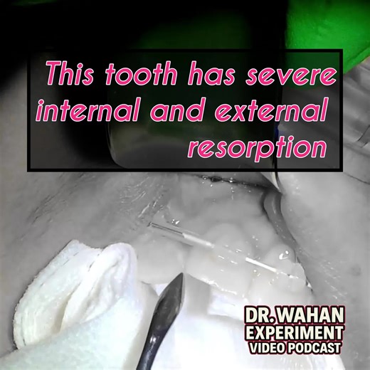 Careful extraction of a hopeless tooth with severe resorption in between mobile teeth. Find the color versions of my videos on my YouTube #drwahan #severeresorption #pinktooth