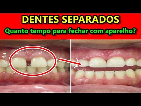 I have gapped teeth - how long does it take to join them with braces?
