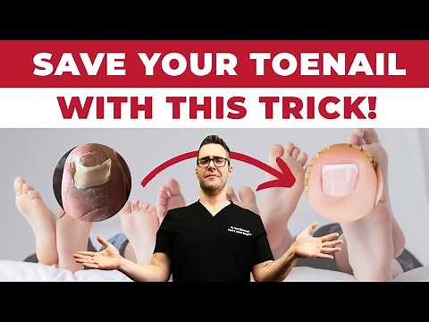 Toenail Falling Off? Do This Trick!