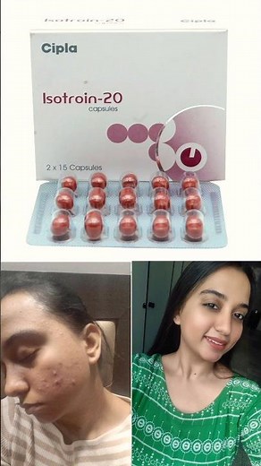 Acne Miracle or Nightmare? Isotretinoin ip capsule 20mg #isotretionion20mg #acnetreatment #acne