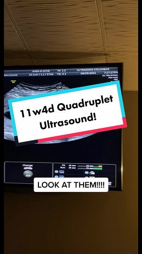 11w4d Quadruplet Ultrasound Sneak Peek