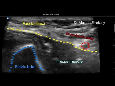 Suprainguinal fascia iliaca block ultrasound guided