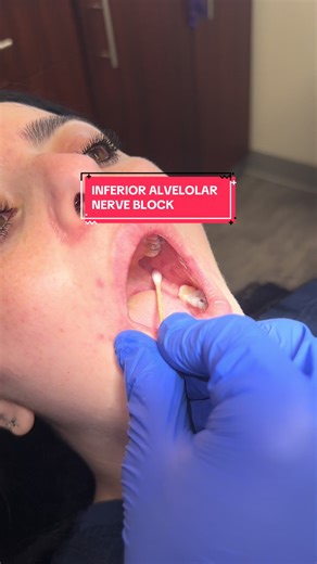 Demonstrating Inferior Alveolar Nerve Block & Helpful Tips