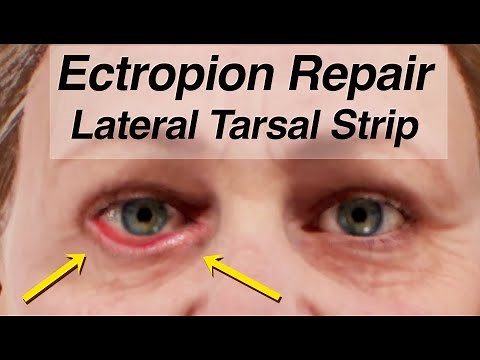Ectropion Repair Using a Lateral Tarsal Strip (Lower Eyelid Drooping After Facial Paralysis)