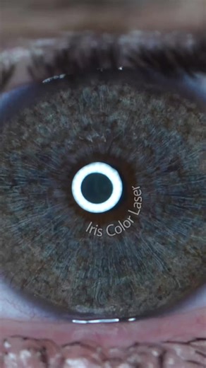 Iris Color Laser on TikTok