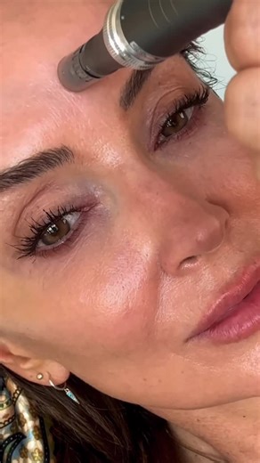 Annie Lewis on Instagram: "Bringing you the latest - Introducinggggg H Y D R O G L O W ! 🤌🏽If you’ve heard of SkinVieve our new HydraGlow is the luxurious Korean version of that! 💉 It is a meso & or needle formulation that gives Deep hydration & radiance. 🧬 The HA gel attracts and binds water molecules in the dermis, resulting in plumper, more luminous skin ￼. 🧪One can expect diminished fine lines, texture improvement and may minimized pore appearance. 📝 This is supposed to yield a lasting