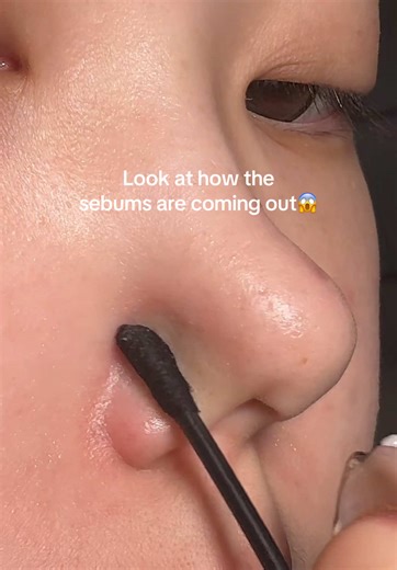 You don’t have to worry about it giving you breakouts like oil cleansers✨#dralthea #oilpulling #sebumcleanser #blackheads #skincaretips