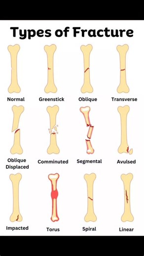 Types of bone fracture # . . #bone #fracture #bonefracture #mbbs #mbbsstudent #viral #medical #tranding #nursing #doctor #nursingstudent #doctors #neetpg #fmge #neetpgpreparation | medicalmania007