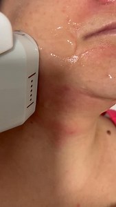 ✨Want a facelift without surgery? ✨ Try our HIFU therapy. Lift, tighten, and glow naturally! #nonsurgicalfacelift #hifu #skintightening #beautyboost #australiancosmetichub | Australian Cosmetic Hub