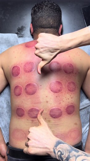 asmr cupping😍 | cupping