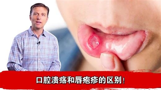 口腔溃疡和唇疱疹的区别！