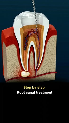 Root canal treatment: Steps #RCT #rootcanaltreatment #rootcanaltherapy #RootCanal #rootcanalspecialist #endo #endodontics #dentistry #dentist #dentalclinic #3d #animation #education #educational #tooth #teeth | Dental Daily