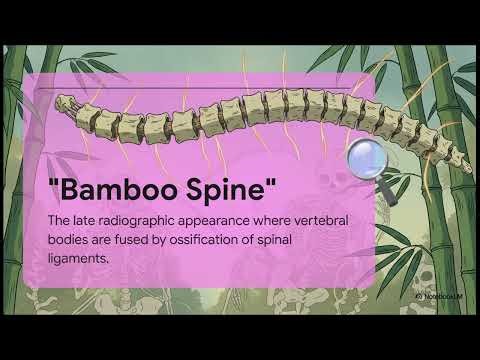 Ankylosing Spondylitis PANCE Buzzwords and Study