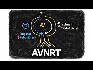 AV-Knoten Reentry Tachykardie (AVNRT) einfach erklärt