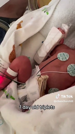 Brave 1-Day-Old Triplets: A Newborn Miracle