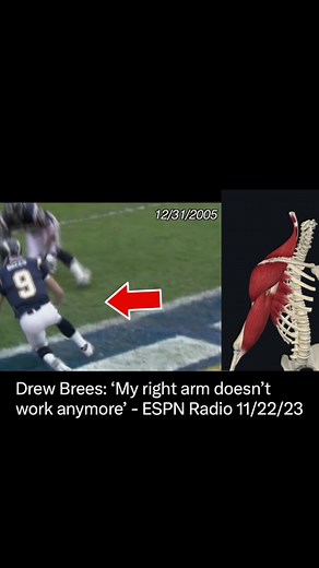 This might have been one of the RAREST & WORST shoulder injuries in NFL history! FULL VIDEO on youtube! Former #Saints & #Chargers QB Drew Brees revealed earlier this week that he can no longer throw over-hand using his right arm d/t this injury (2005). Many doctors told #drewbrees he would never throw a football again in the #nfl after this injury, that didn’t stop him from leading the #whodatnation to a #superbowl victory in 2010 🔱🏈 #Medspiration . . . #nflnews #nfltiktok #boltup #boltup⚡️ #