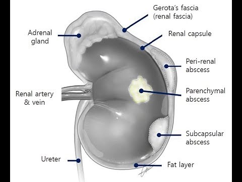 Perinephric Abscess ; Definition, Causes, Symptoms, Diagnosis, Treatment and Complications
