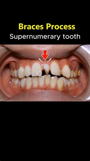 Dentistry blog | Braces for supernumerary tooth By @nhakhoaocare #braces #dentist #orthodontist #teeth #tooth | Instagram