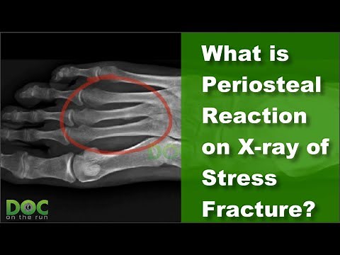 What is Periosteal Reaction on X ray of Stress Fracture?