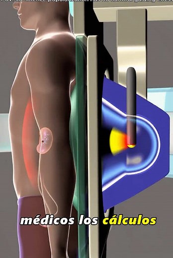 Effective Methods for Painless Kidney Stone Removal