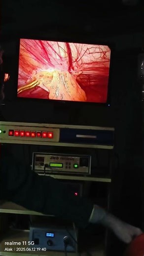 omentum released in laparoscopy #surgerysuccess