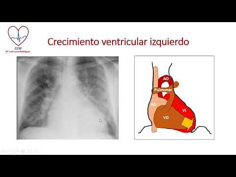 Crecimientos ventriculares en la radiografia PA de tórax