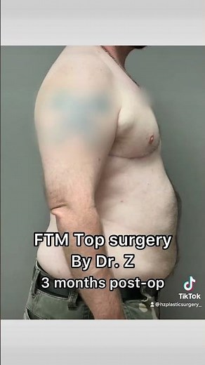 FTM Top surgery at 3 months post-op by Dr. Z 😍