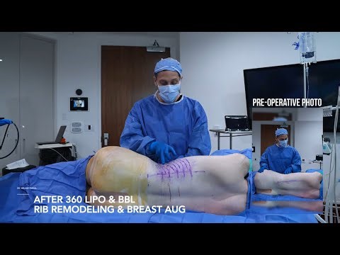 Full Gender Affirming Transformation | 360 Lipo, BBL, Rib Remodeling + (MTF Top) Breast Augmentation