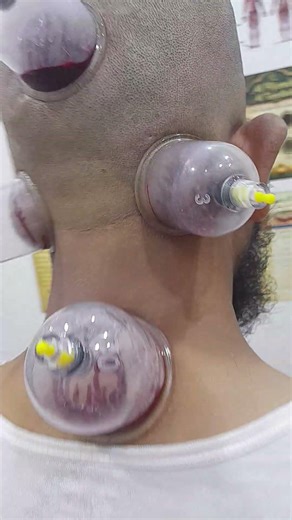 Head Hijamah - Part 2
