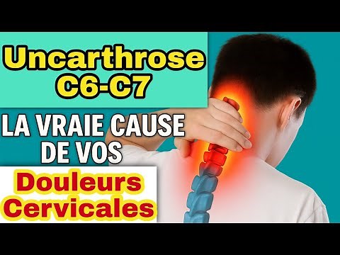 Neck and Arm Pain? Finally Understand C6-C7 Uncarthrosis