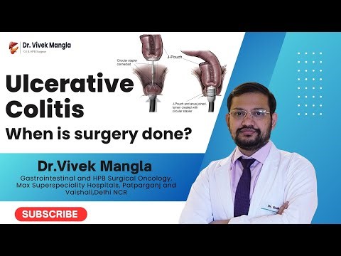 Surgery for Ulcerative Colitis: When, Why and Benefits