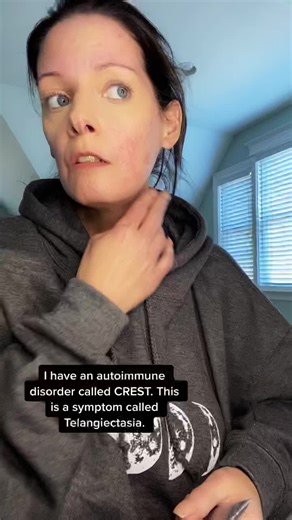 Discover the Best Treatment Cream for Calcinosis Cutis with IT Cosmetics