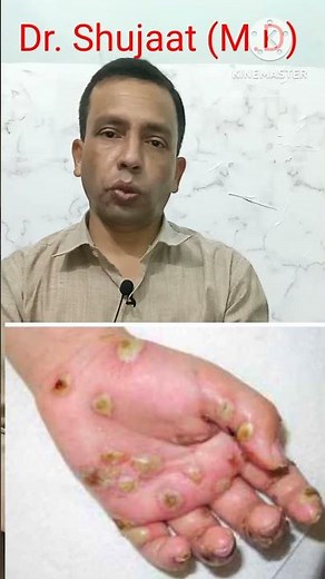 Scabies, Causes, Symptoms and Treatment. (Khujli ka ilaj)