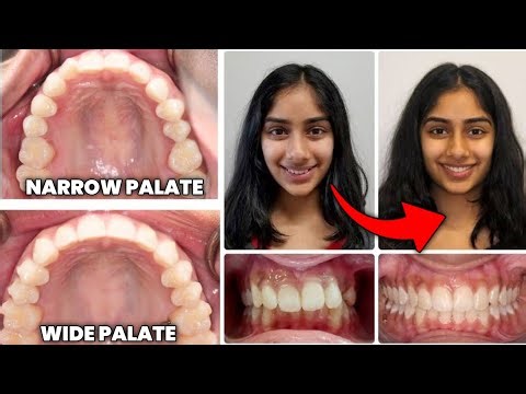 Narrow Palate Explained (Fix Your Face Structure)