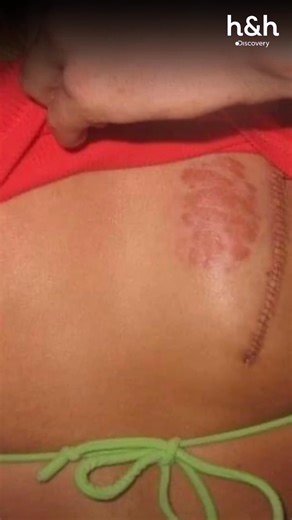 💉⚠️ Esta paciente sufre de un doloroso bulto en su espalda causado por la Neurofibromatosis. La doctora Lee deberá tomar una decisión crítica para tratarlo 👩‍⚕️😱 #DoctoraSandraLeeEspecialistaenPiel Disfruta el contenido de Discovery en #HBOMax Suscríbete ahora: https://bit.ly/MAX-HHLAT | Discovery Home & Health