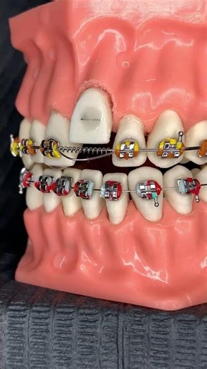 🔥Combining Forces with Metal Orthodontic Braces🔥